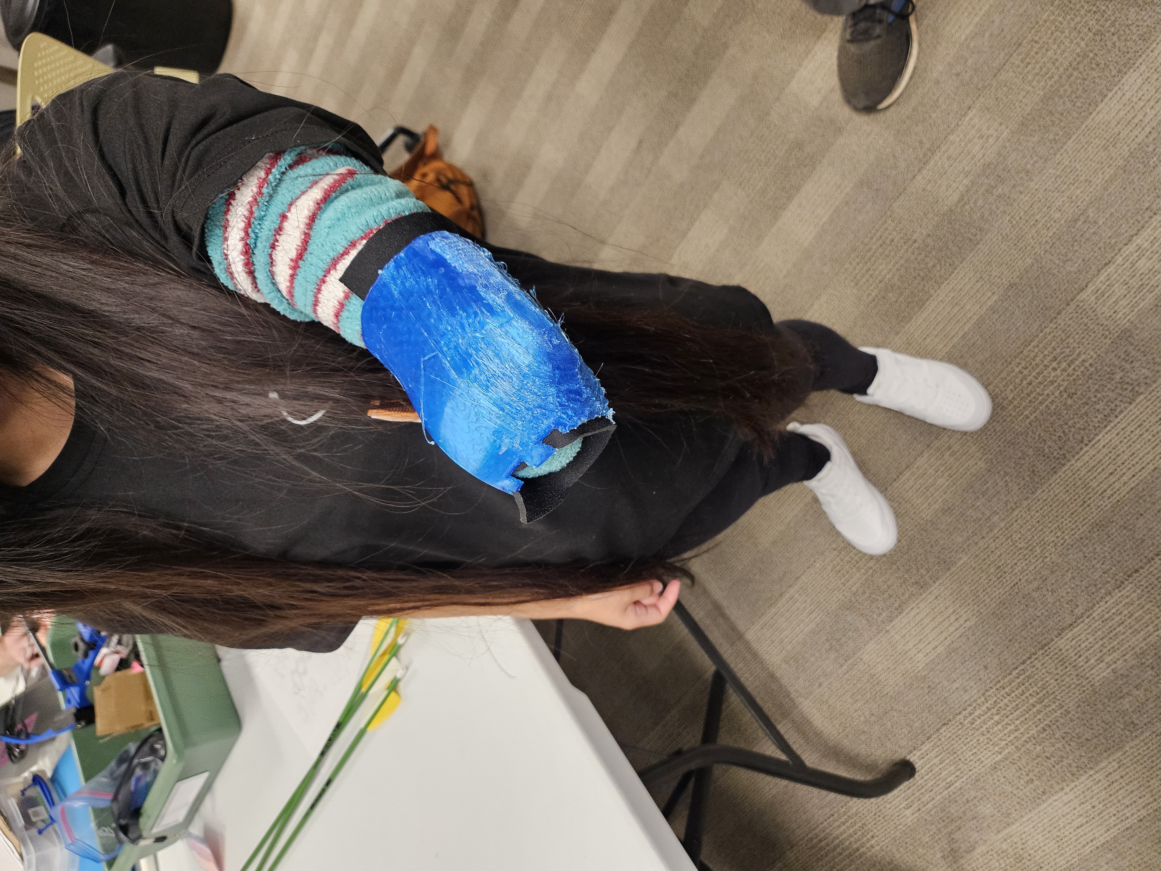Form 5 COFAB — blue prosthetic prototype being fitted, Columbus OH 2024